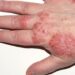 Eczema -What Dr Aman Aditya Pandey Says