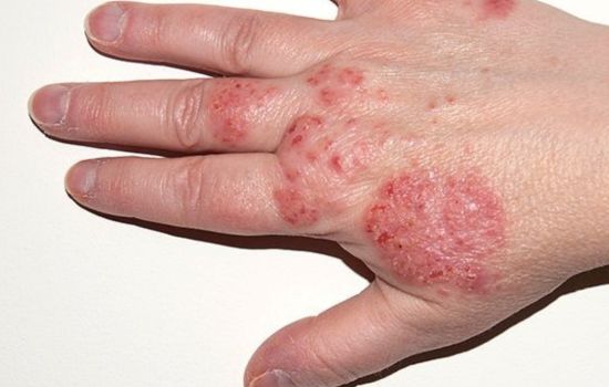 Eczema -What Dr Aman Aditya Pandey Says