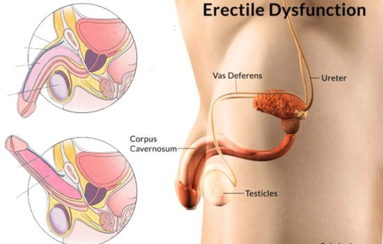 Erectile dysfunction