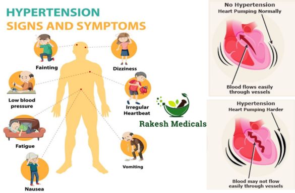 Understanding Hypertension A Comprehensive Guide by Dr. Aman Aditya Pandey