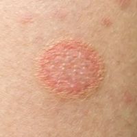 Skin Infection